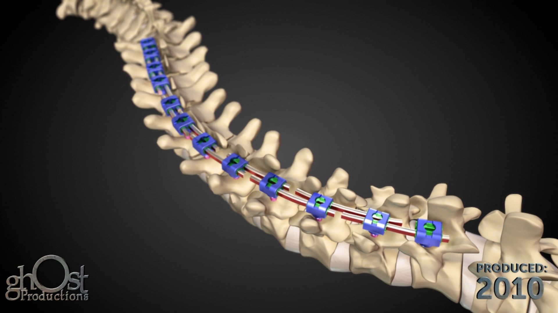 Ghost Medical presents: MIND - The Intelligent Implant System