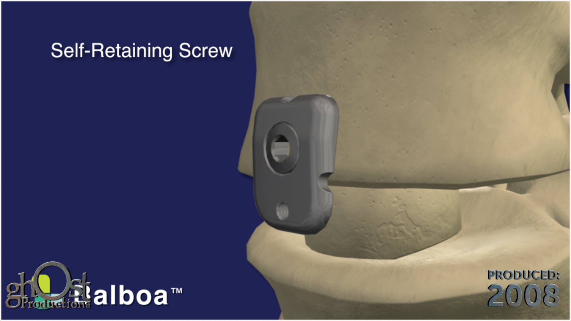 SeaSpine, Balboa device, Anterior Buttress Plate, one screw, one plate design, spacer migration, Ghost Productions, informative animation, key features, dimensions, text, medical professionals, orthopedics, clear representation, benefits, medically accurate depiction, search engines, essential resource, groundbreaking product.