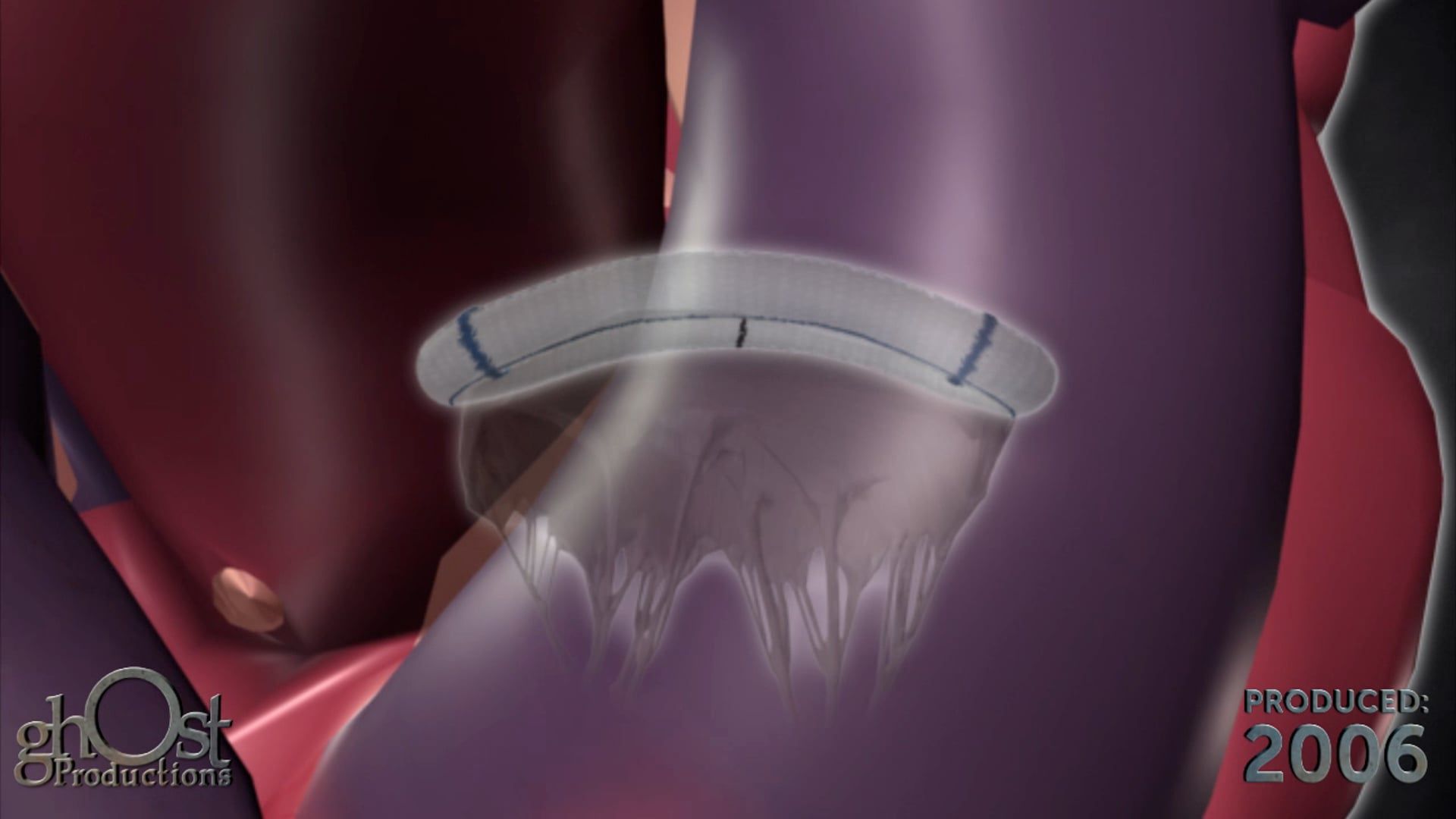 Revolutionizing Cardiac Surgery with Ghost Medical's SaddleRing Technology