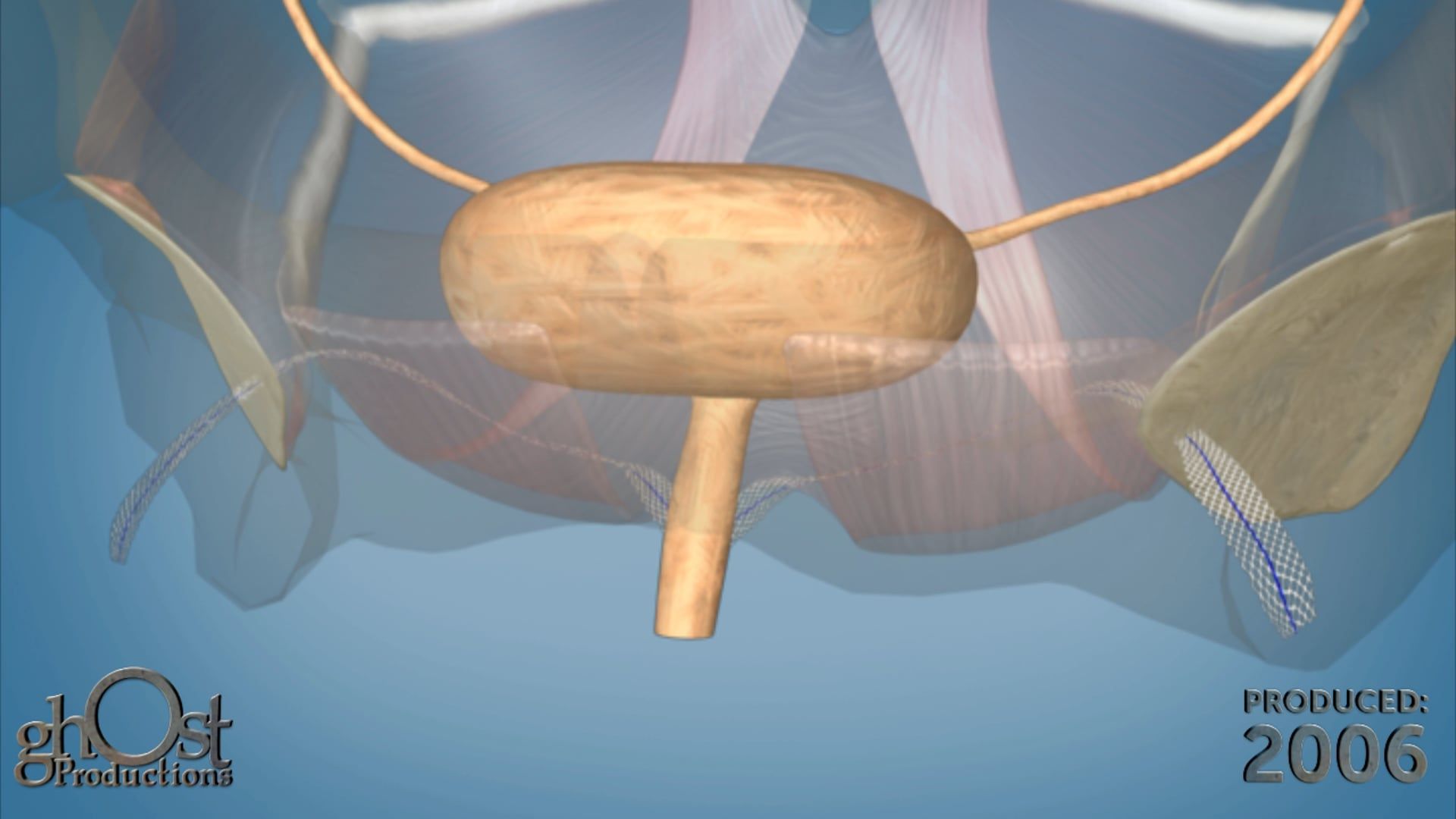 Ghost Productions partnered with American Medical Systems to create an animation showcasing the benefits of the Monarc device for bladder and vaginal prolapse.