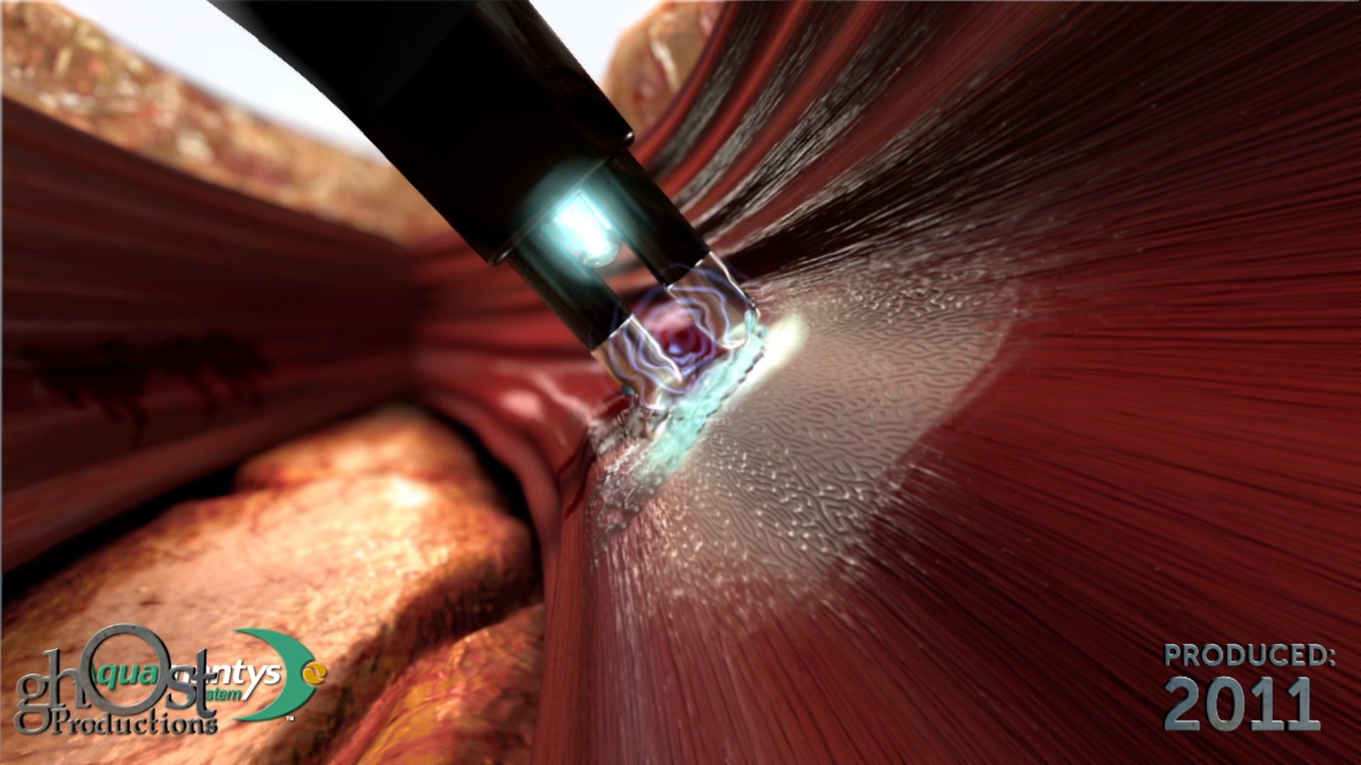 Ghost Medical Presents: The Salient Aquamantys Technology