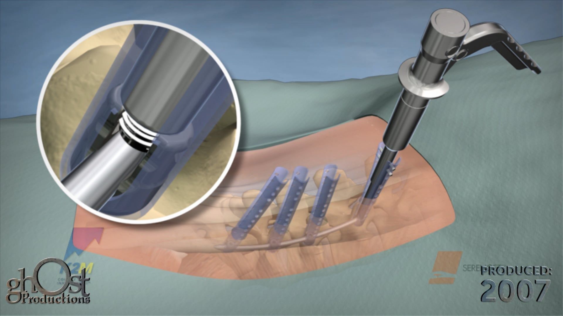 medical animation, K2M Serengeti device, minimally invasive retractor system, surgical precision, orthopedic surgery, percutaneous placement, screw and retractor, direct visualization, innovative product, safer alternative, traditional retractor systems.