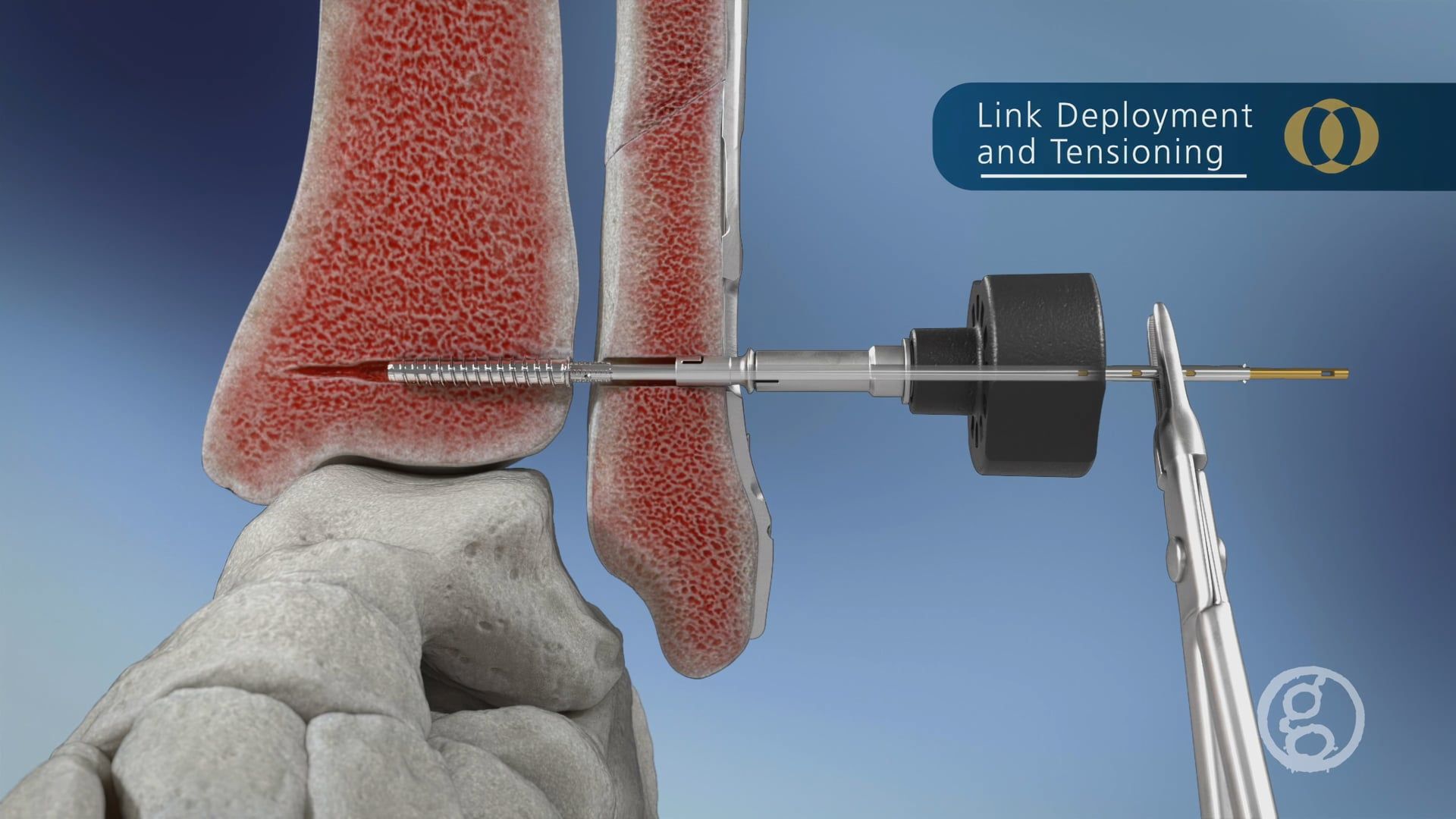 Ghost Productions DePuy FibuLINK Surgical Technique | Video