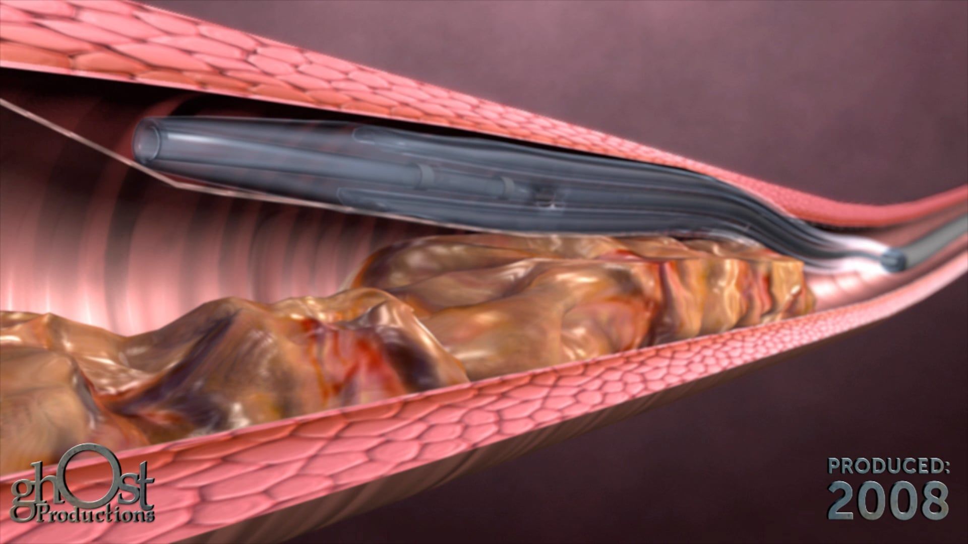 Ghost Medical's BridgePoint Final Animation