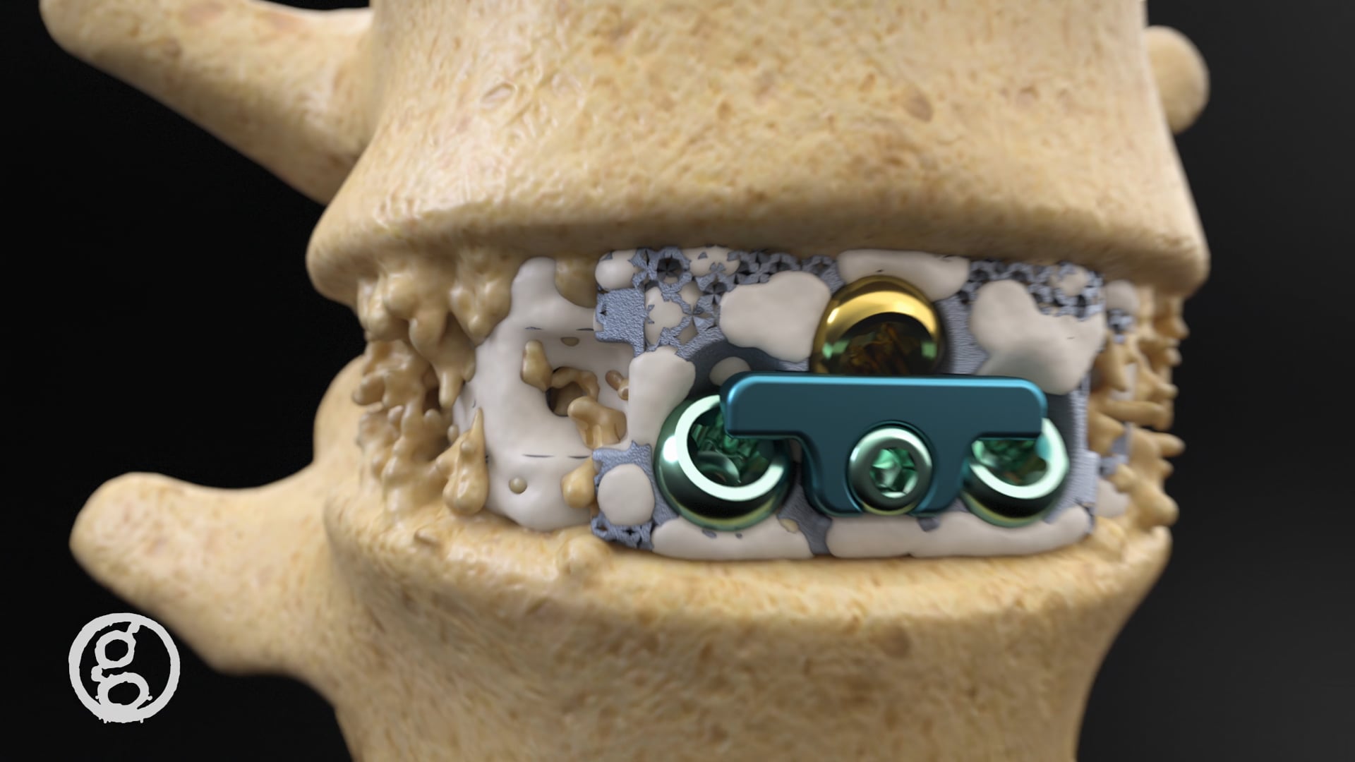 NanoHive Medical Device Marketing Animation, The Hive ALIF Cage - Ghost Medical Innovations