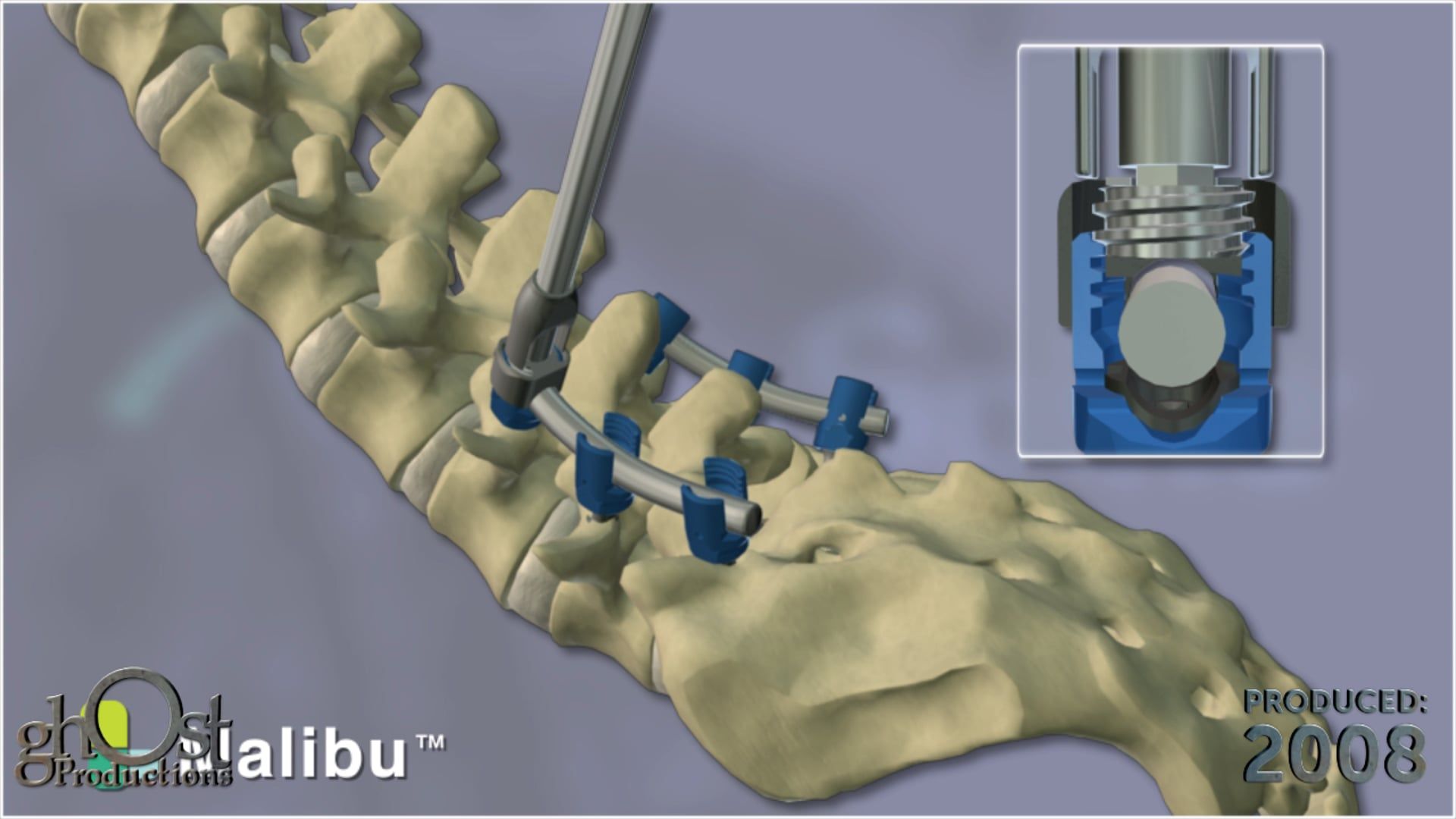 Ghost Medical Presents: SeaSpine Malibu - A Revolutionary Surgical Solution