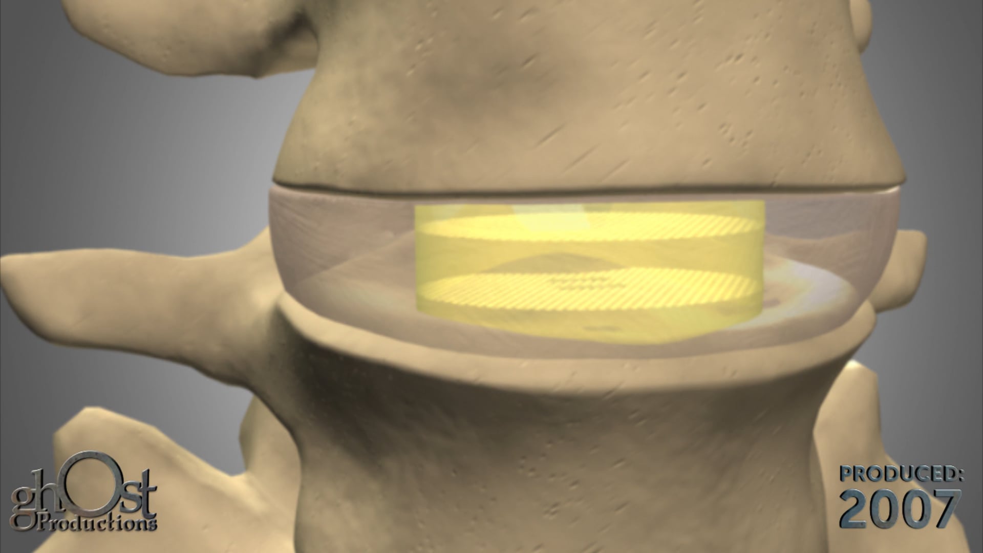 Ghost Medical Presents: Replication of NeuDisc