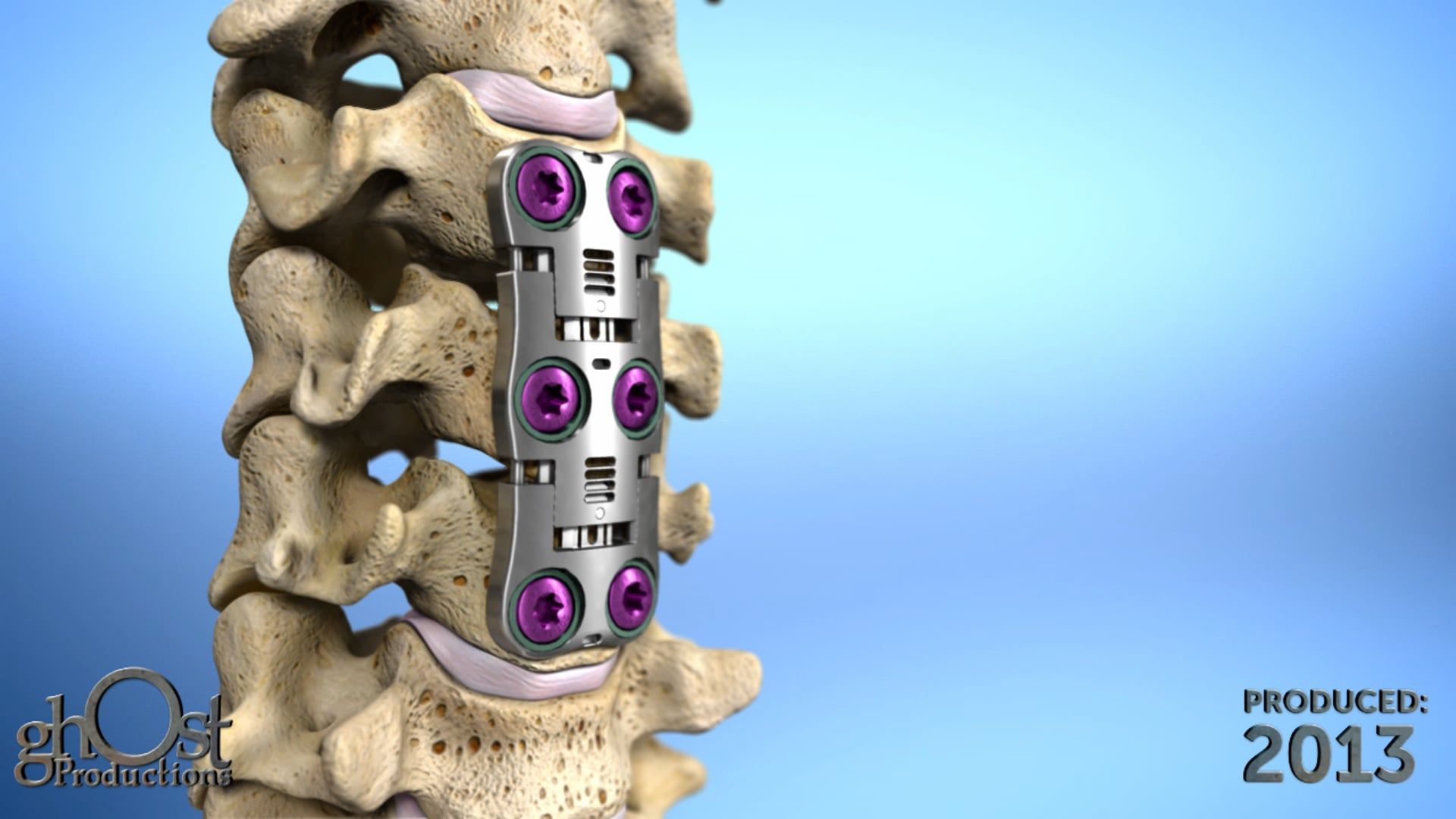 Ghost Medical Presents: K2M PYRENEES Surgical Technique Animation