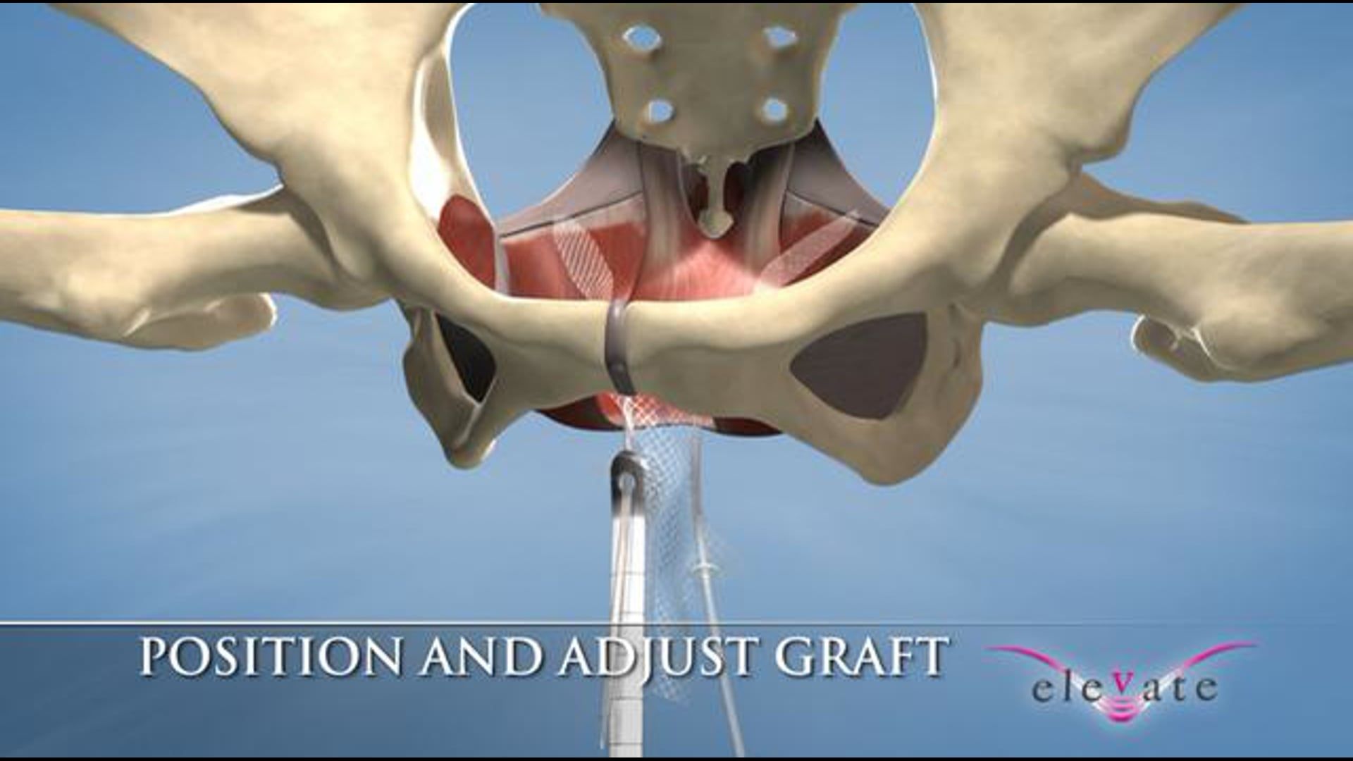 3D Urology Video - Medical Animation Reel - Ghost Medical
