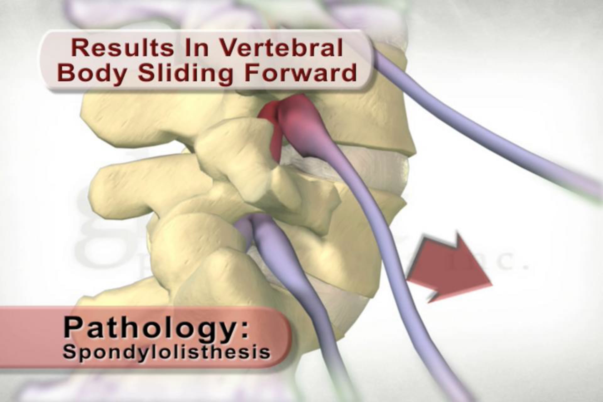 medical animation, lamina integrity, vertebral body sliding, nerve irritation, pedicle structure, medical condition, medical products, educational video, Ghost Productions, 2006, .edu websites, .org websites, medical resources, medical education, medical treatment, medical understanding.