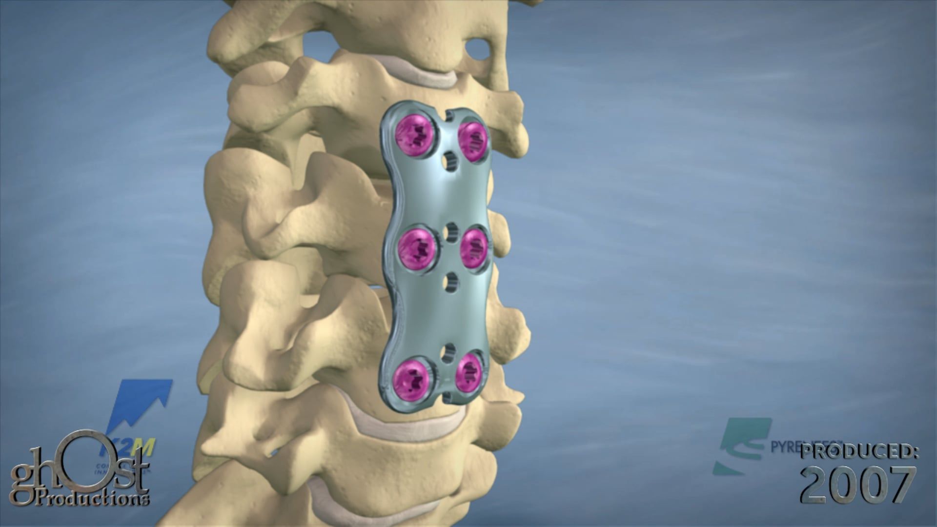 K2M, Ghost Production, surgical technique animation, Pyrenees device, anterior cervical plating system, fixation, discectomy, orthopedic medicine, unique features, benefits, cervical spine surgery, medically accurate, visually engaging, product promotion, medical professionals, spinal surgery technology.