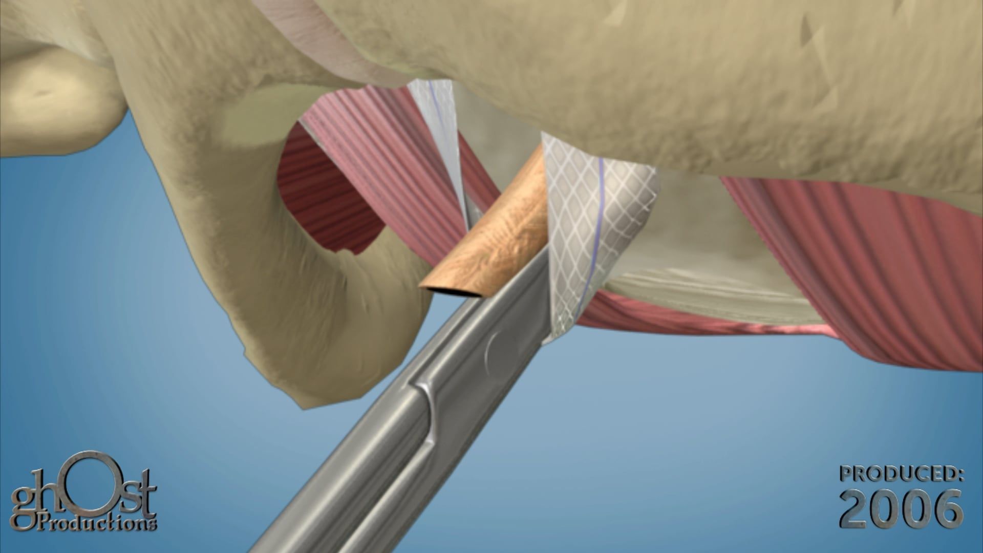 SPARC vaginal mesh with guide suture for optimal placement is an effective treatment for bladder and vaginal prolapse. Trust Ghost Productions for medical animations.