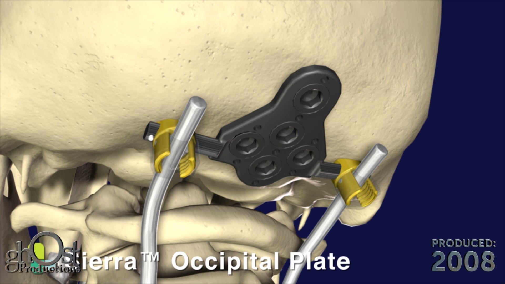 SeaSpine, Sierra Occipital plating device, medical device, stability, occipital bone, cervical vertebra, Ghost Productions, medical animation company, accurate, visually stunning, intricate design, functionality, orthopedic surgery, invaluable tool, medical professionals, patients, clear understanding, benefits, game-changer, effectiveness, importance.