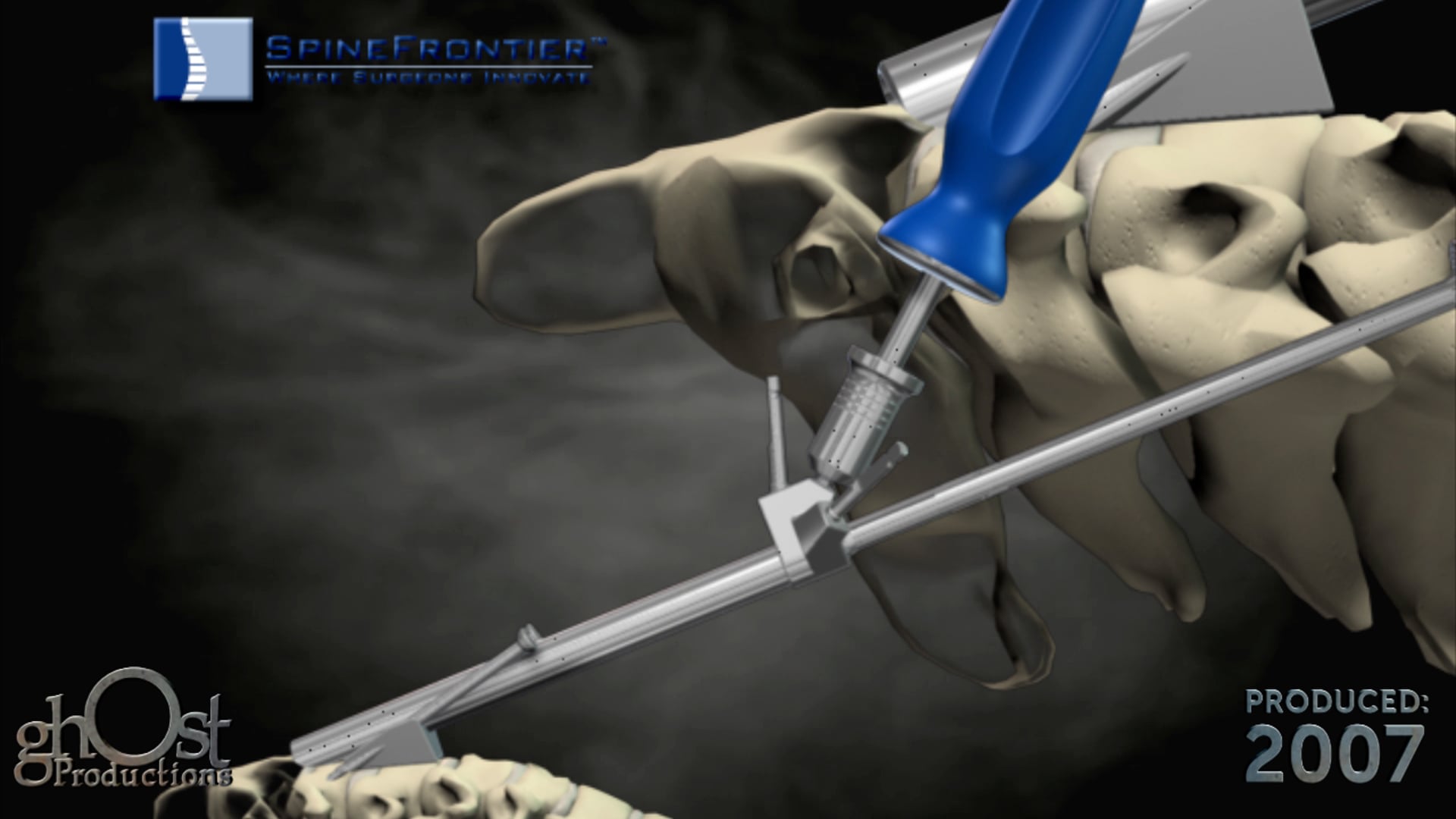 Ghost Medical presents: Spine Frontier Odontoid Animation