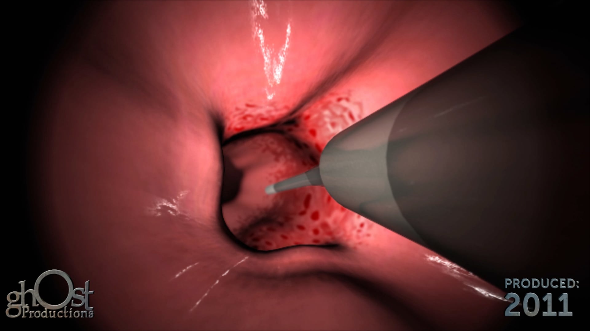 Ghost Medical's RF Ablation Animation: A Comprehensive Guide
