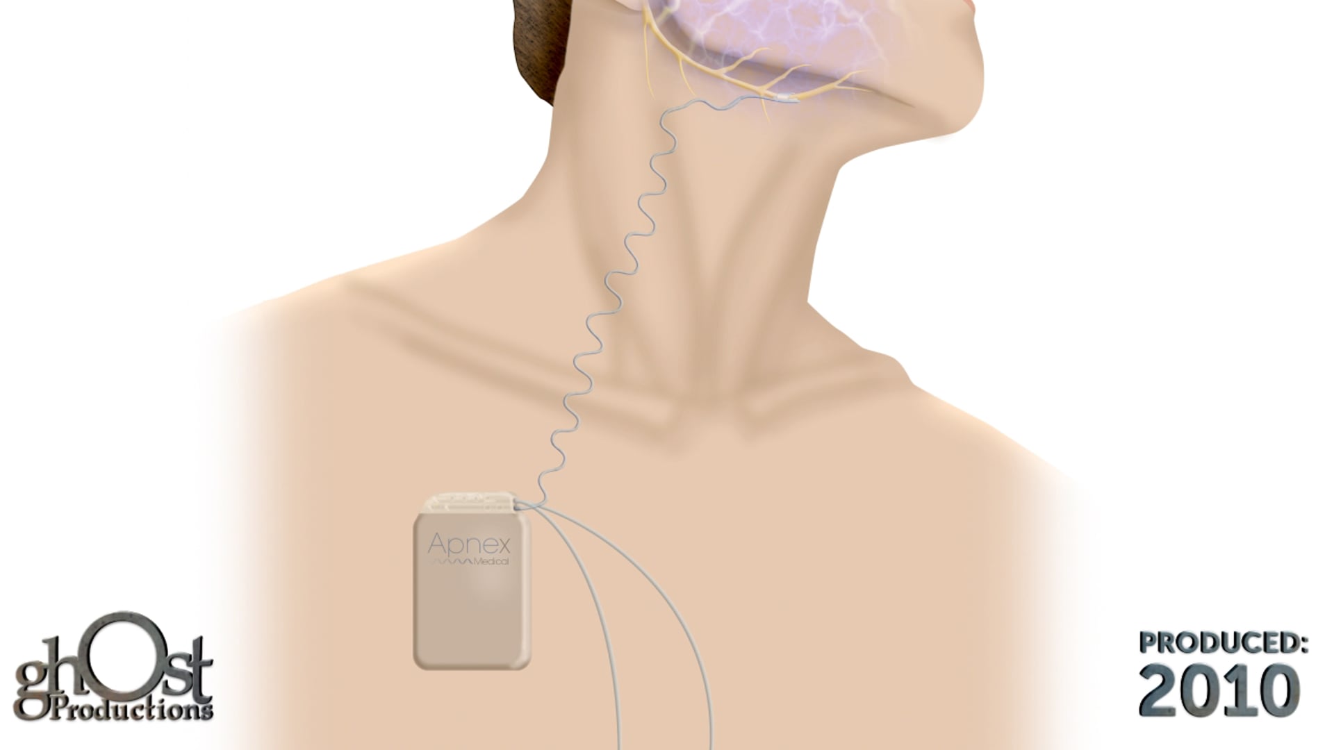 Watch Ghost Productions' animation showcasing Apnex's electrical stimulus device for sleep apnea treatment. A game-changer in sleep medicine.