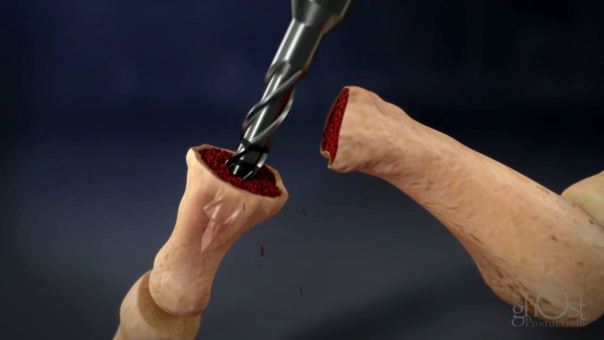 Ghost Medical - Osteomed - ExtremiFuse - HD