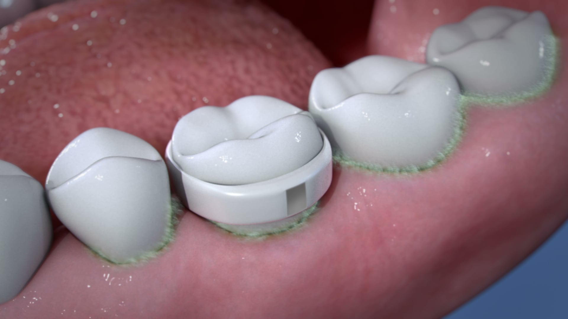 U-CHU Dental PH Sensor: Ghost Medical Animation
