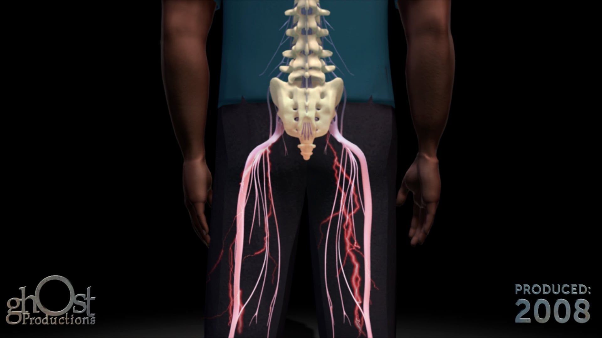 Ghost Productions, medical animation, spinal stenosis, xStop surgery, minimally invasive procedure, patient education, healthcare professionals, medical accuracy, search engine optimization.