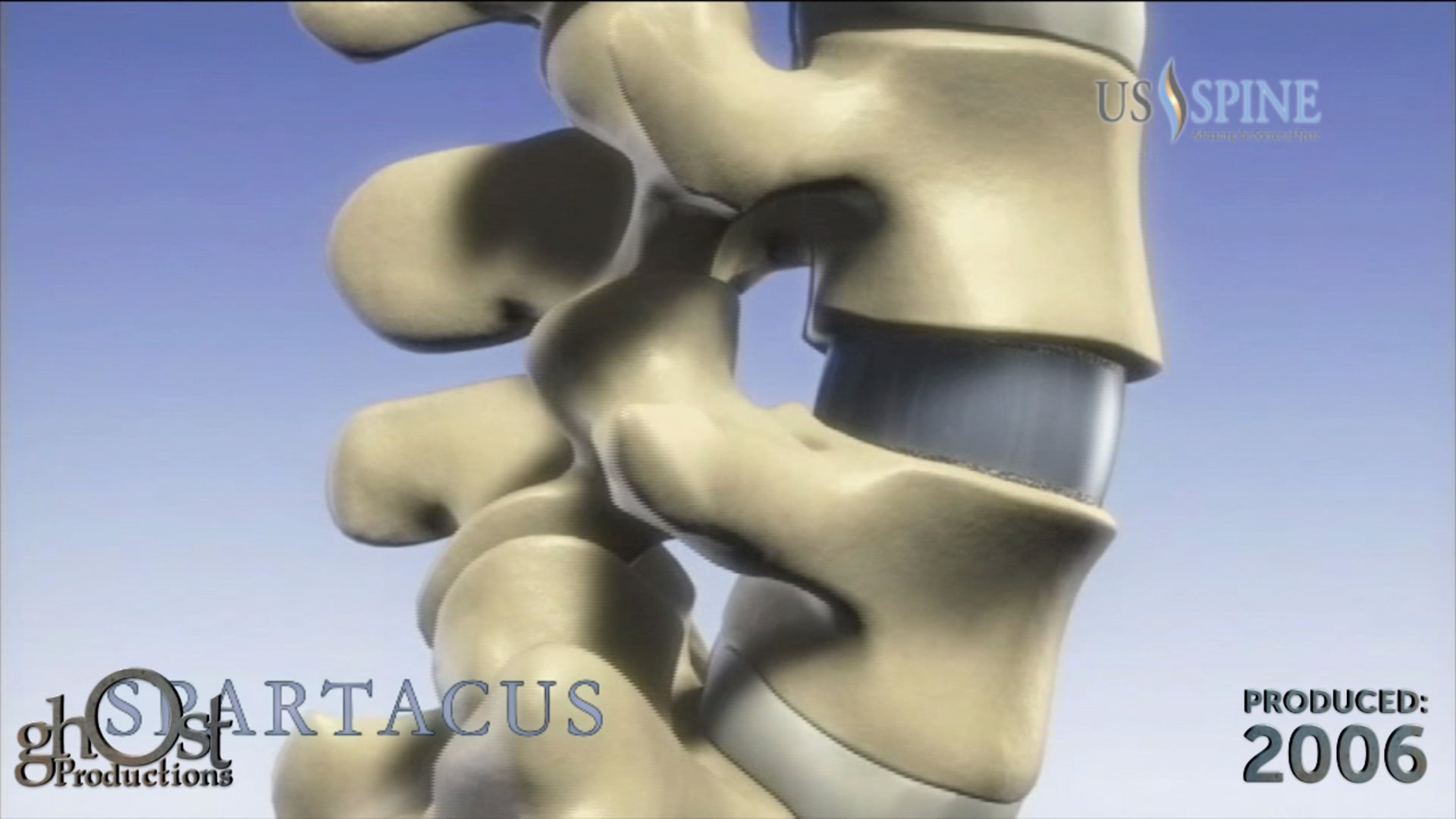 US Spine, medical device company, Ghost Productions, animation, Spartacus disc implant, facet fixation technology, chronic back pain, spine stabilization, proper alignment, spinal conditions, innovative products, patient outcomes, spinal medicine, medical advancements.