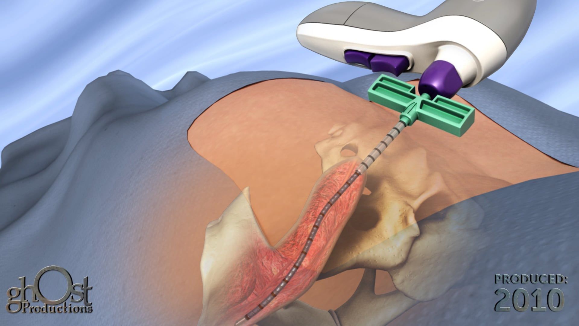 Ghost Medical Presents: The Hospira MarrowMiner Animation