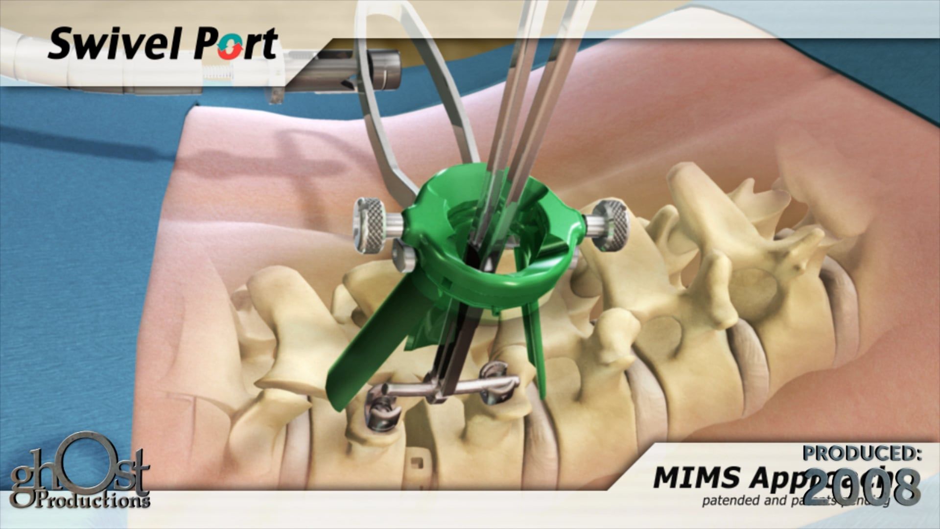 Ghost Medical presents: Spine Surgical Innovations SwivelPort