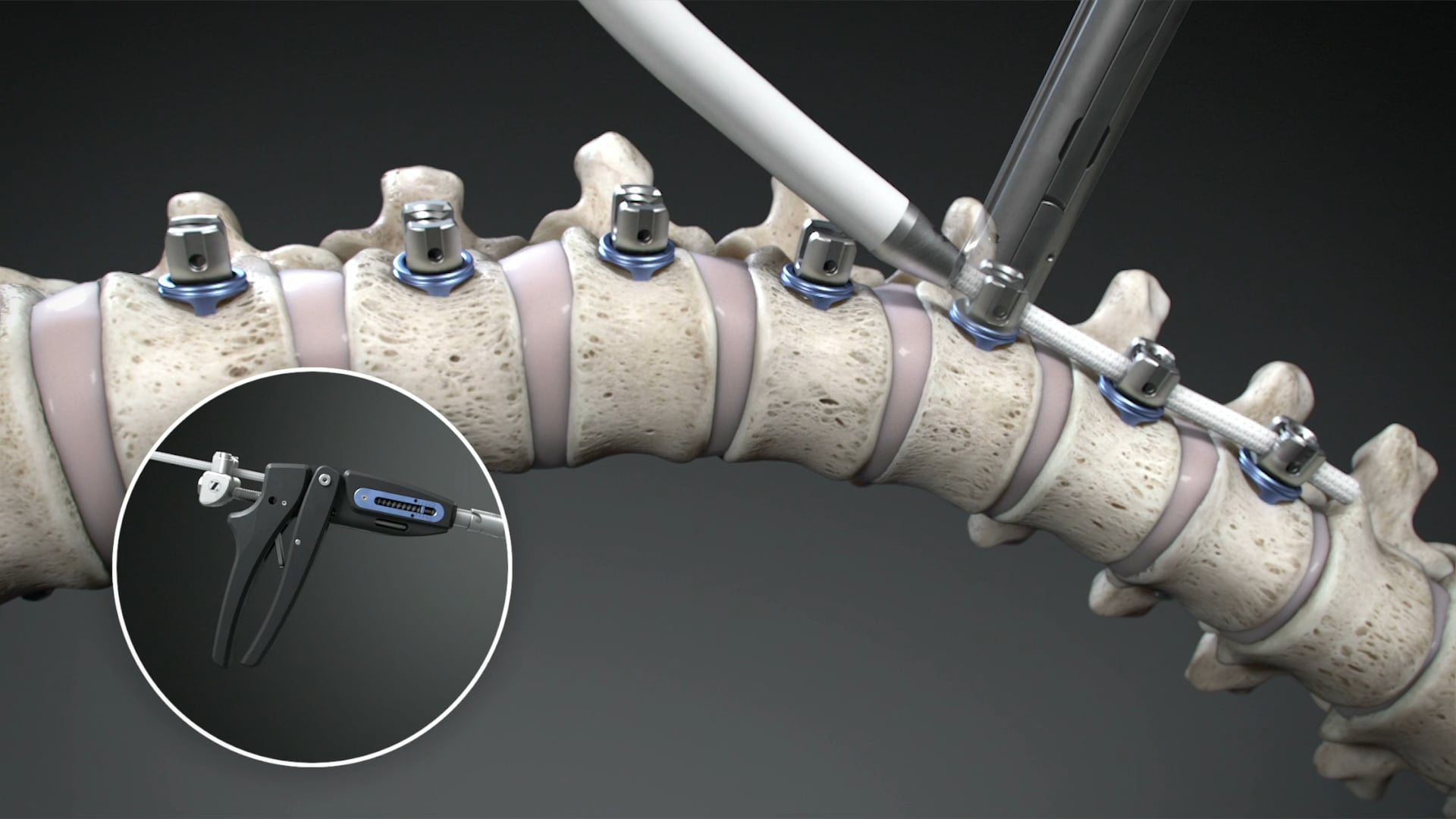 Ghost Medical's Zimmer Biomet Tether Surgical Technique Animation