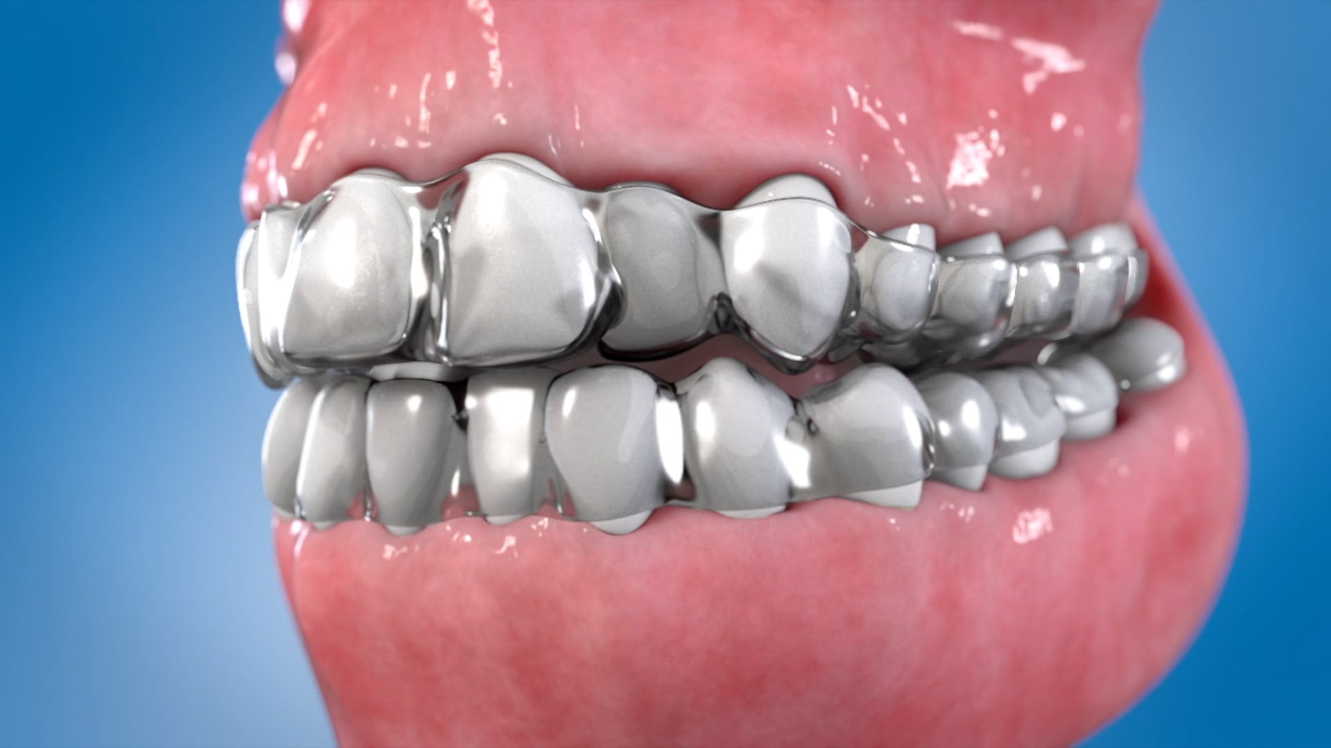 Ghost Medical Presents: ClearAligners for Dental Treatment