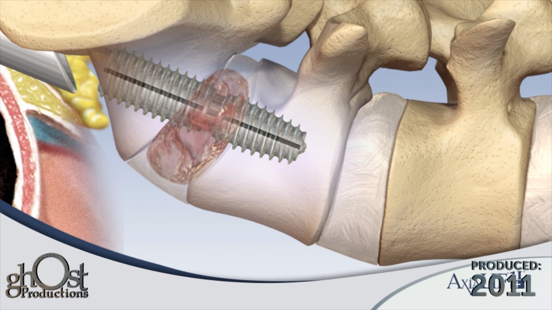 Revolutionizing Spinal Surgery with Ghost Medical's TranS1 AxiaLIF1L