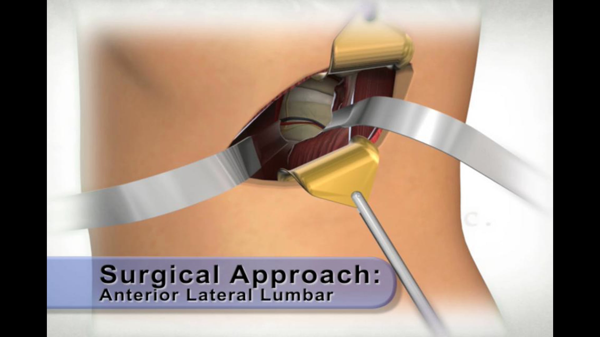 medical animation, anterior lateral lumbar surgical approach, surgical procedure, retracting skin, external muscle, internal soft tissue, cutting vessels, resecting sympathetic nerve, medical education, medical professionals, medical students, .edu websites, .org websites, Ghost Productions, 2006.