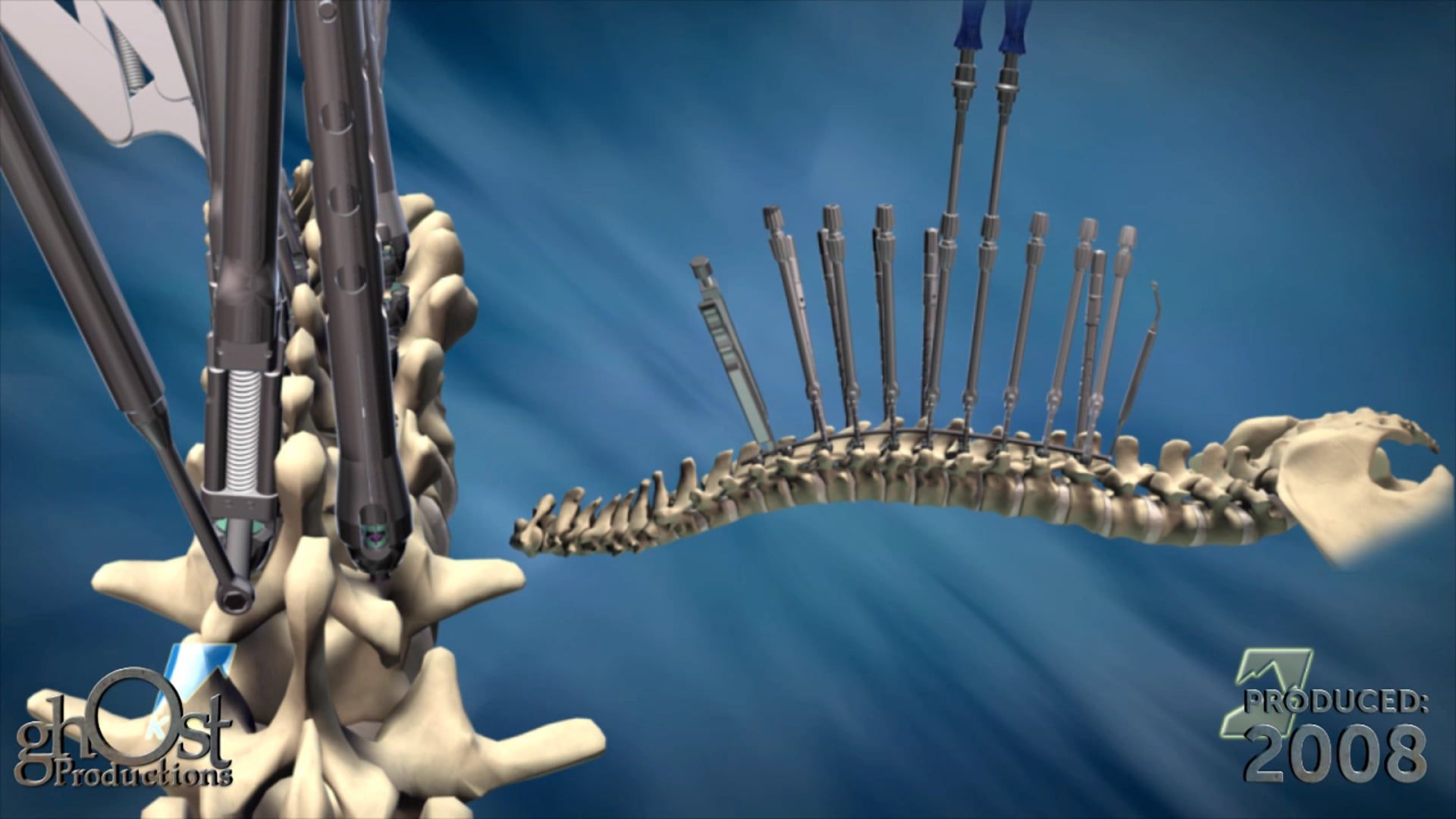 K2M, medical device company, spinal surgery, Ghost Productions, highlight reel animation, product line, 2008 North American Spine Society (NASS) convention, innovative spinal implants, surgical instruments, patient outcomes, surgical complications, medically accurate depiction, healthcare professionals, latest advancements, invaluable tool, Ghost Productions' expertise, medical animation, accessible, informative.
