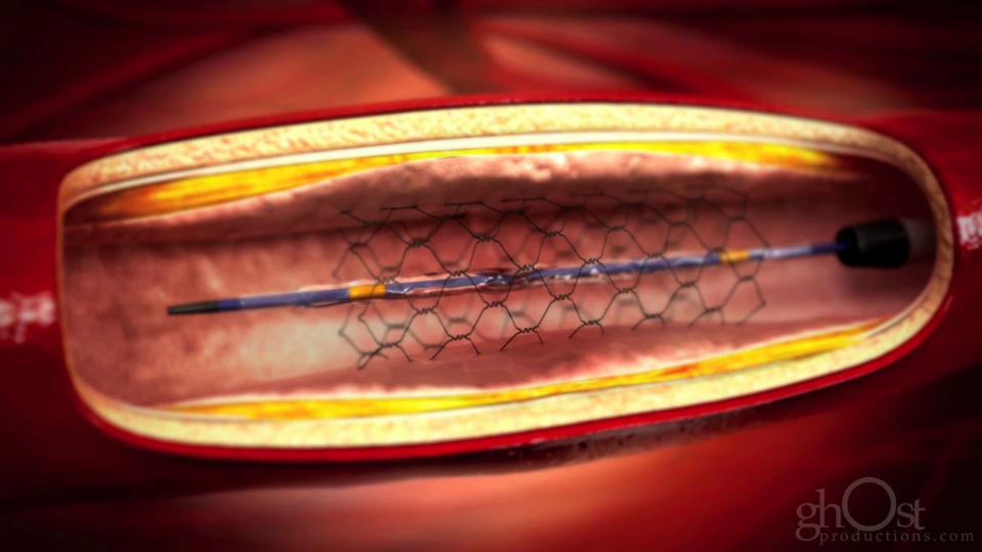Ghost Productions, medical animation, Cardiovascular Institute of the South, CIS, limb salvage team, peripheral vascular disease, complex medical procedures, cutting-edge technology, expertise, visually stunning, 30-second animated commercial spot, advanced treatments, medically accurate content, engaging visuals, search engines, essential tool, medicine.