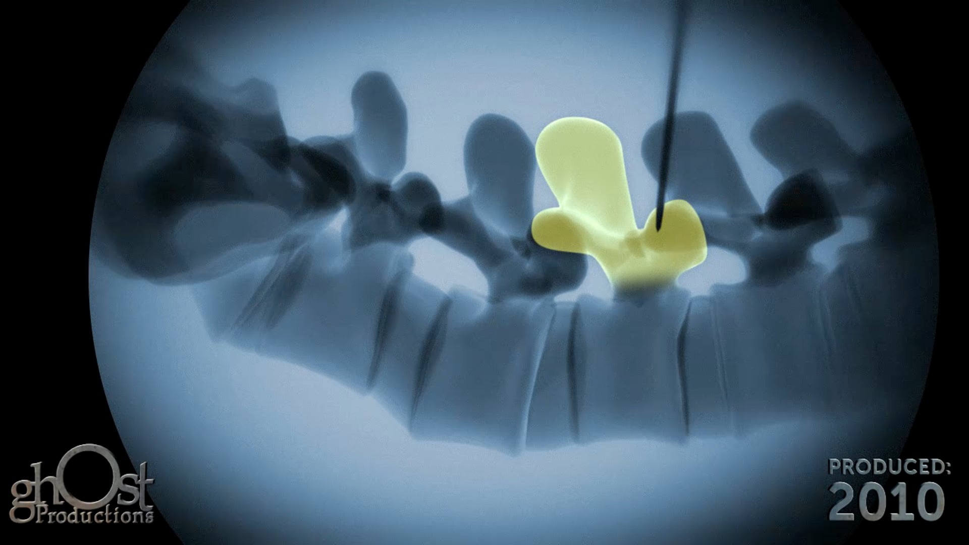 Zimmer, medical device company, Ghost Productions, educational animation, A/P image, lateral image, C-arm fluoroscopy, surgeon, L3 pedicle, step-by-step guide, accurate imaging, orthopedics, spine surgery, medical professionals, invaluable resource, detailed, medically accurate, demonstration, procedure, educational tool, knowledge, skills, optimal patient outcomes.