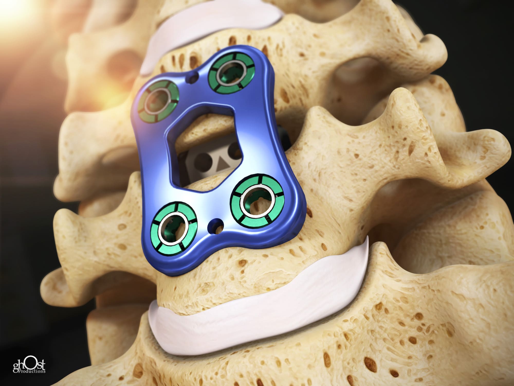 Spinous Process Fixation Animation Case Study: Spineology VIA