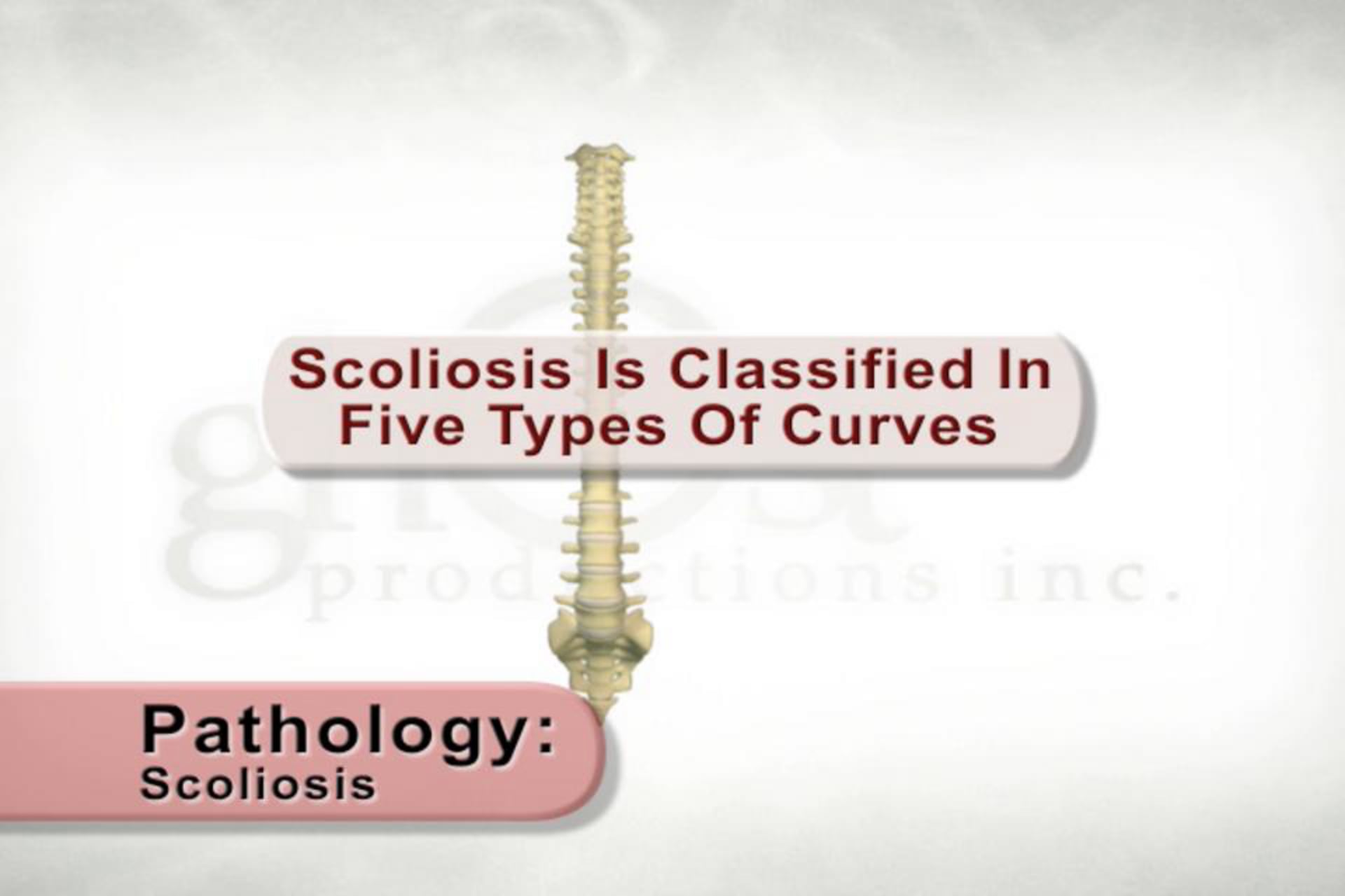 medical animation, scoliosis classification, King Type I, King Type V, Ghost Productions, medical visualization, accurate information, educational resource, medical expertise, lumbar curve, thoracic curve, double concave deformity, double thoracic curve, .edu websites, .org websites, medical services, medical accuracy, medical education, medical knowledge.