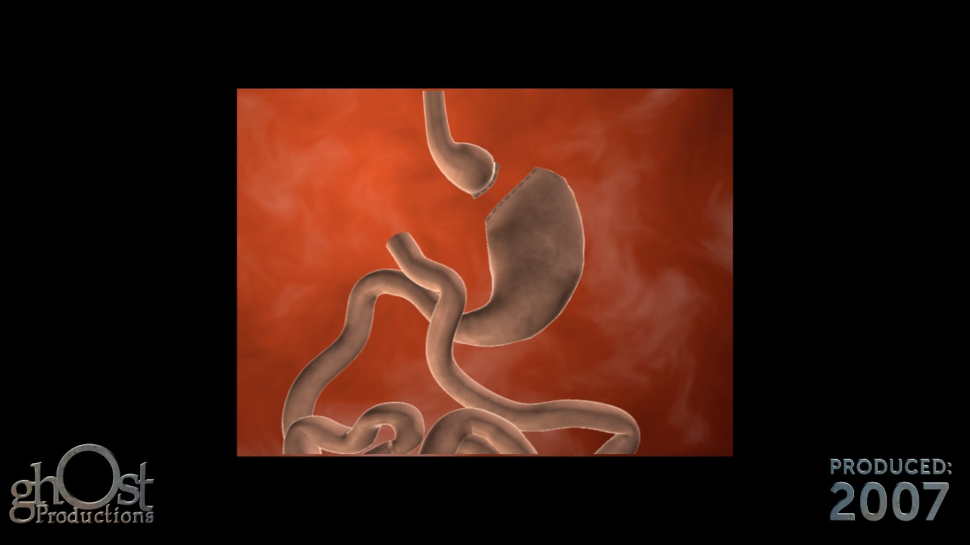 Ghost Medical Presents: Gastric Bypass Surgery Animation