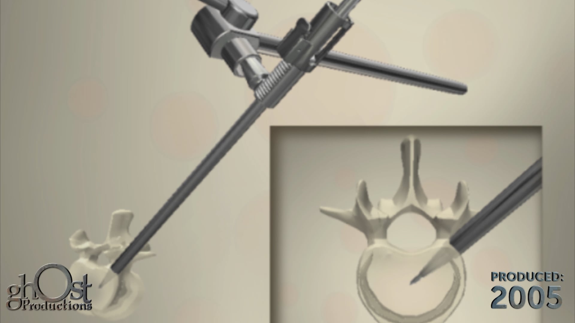 Spineology, Ghost Productions, medical device company, Optimesh system, interbody system, spinal fusion procedures, mesh implant, granular bone graft, expanding instrumentation, precision, effectiveness, medical professionals, spinal surgery, visually stunning, medically accurate, animation, valuable tool, benefits.