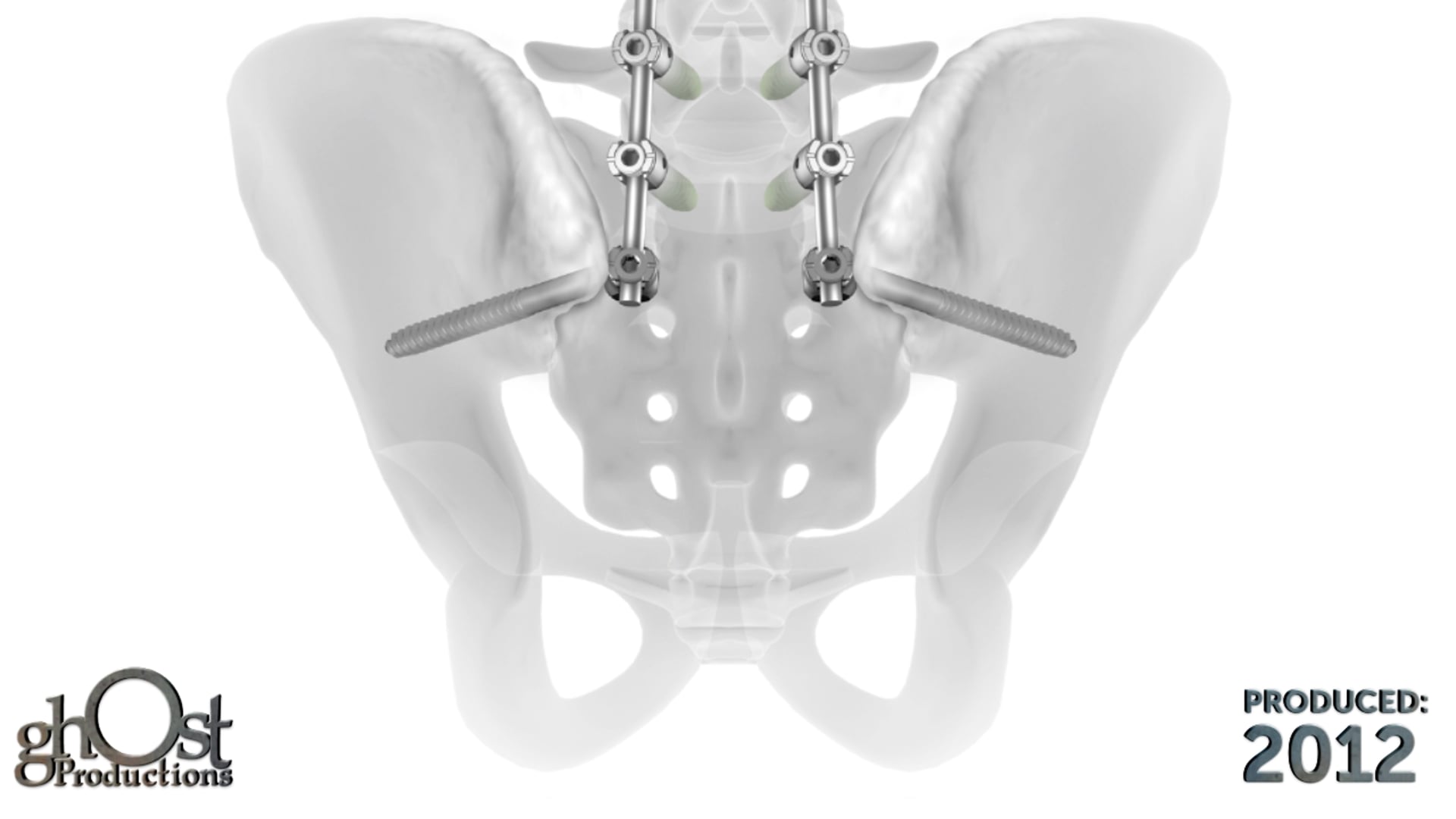 Depuy Spine, Ghost Productions, Viper spine system, medical animation, screw trajectory, pelvis, lower back, precise screw placement, optimal patient outcomes, orthopedic surgery, spinal medicine, search engine results.