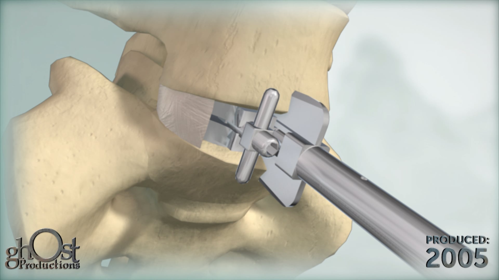 Synthes, ProDisc-L, total disc replacement device, lumbar spine disc disease, motion preservation, medical accuracy, innovative features, natural movement, long-lasting relief, orthopedic medicine, healthcare professionals, patient education, spinal care, Ghost Productions, animation.