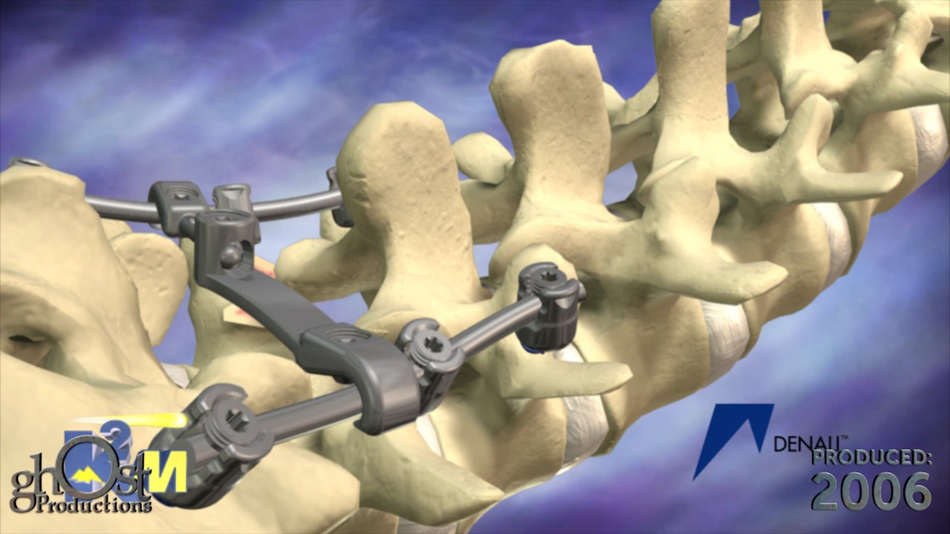 K2M, medical device company, Ghost Productions, corporate demo marketing reel, spinal implant technology, surgical techniques, patient outcomes, orthopedic surgery, 3D animations, medically accurate depictions, surgical procedures, healthcare professionals, patients, surgeon, advancements, spinal surgery, treatment options, informative, engaging resource.