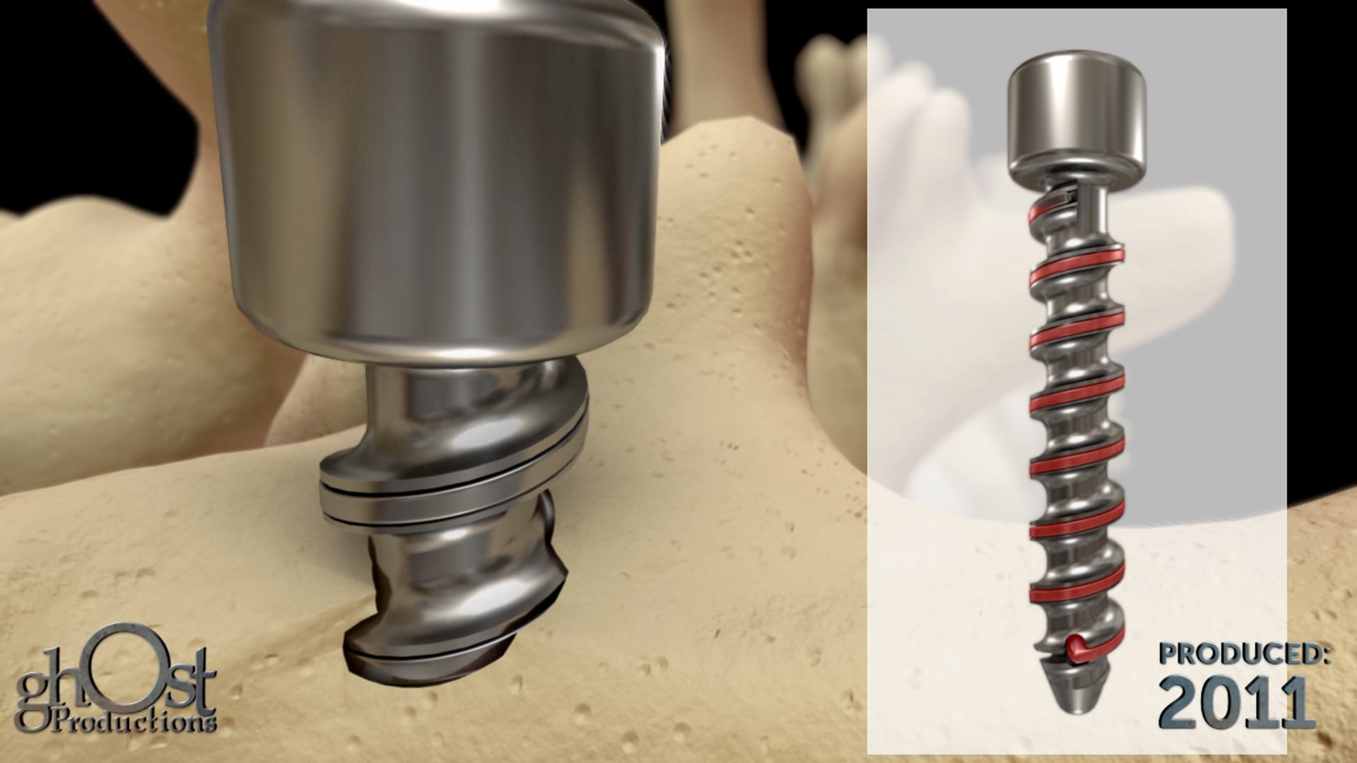 Ghost Medical presents: The Intelligent Implant Systems Active™ Screw