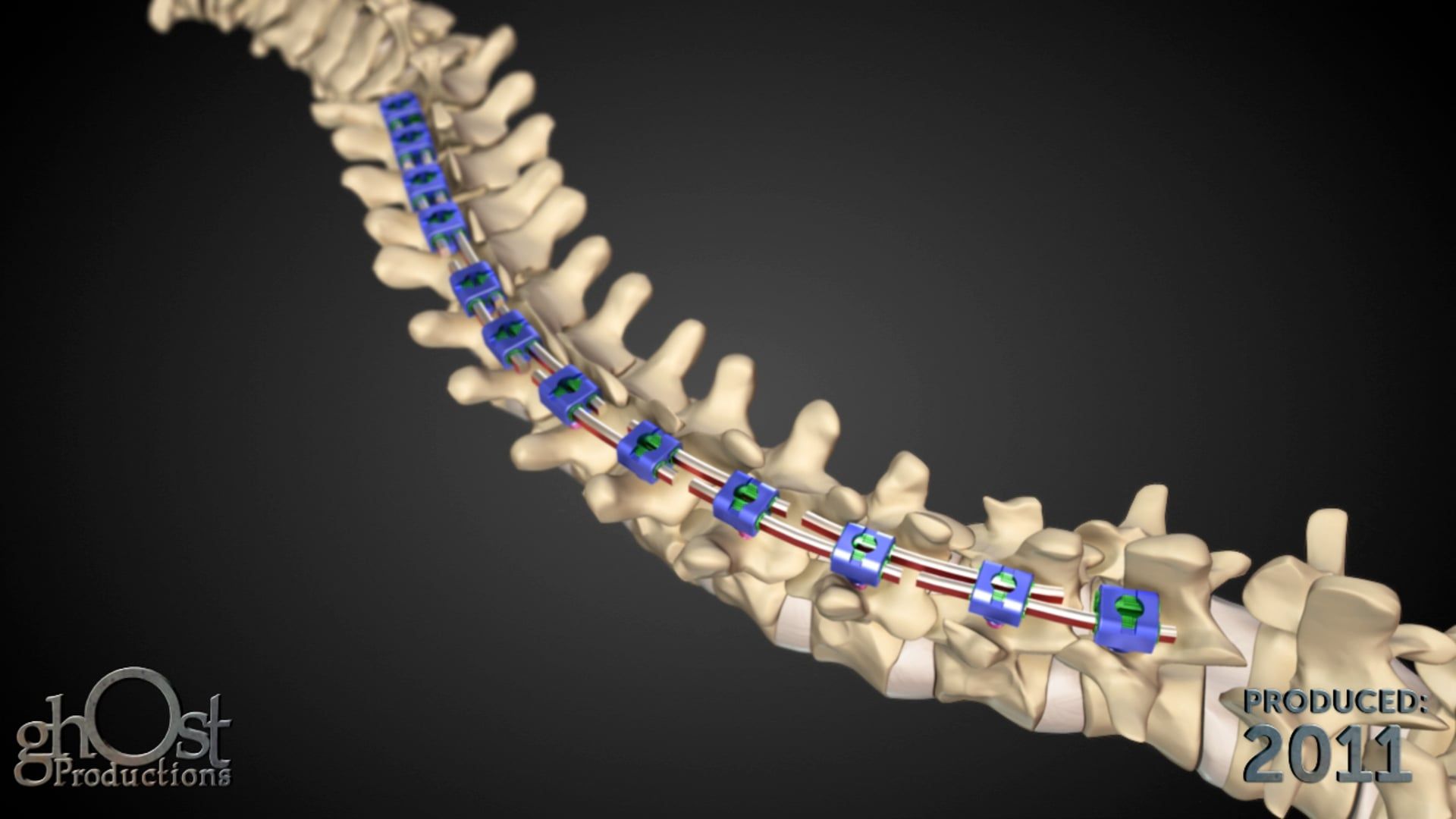 Ghost Medical's Intelligent Implant System Hybrid