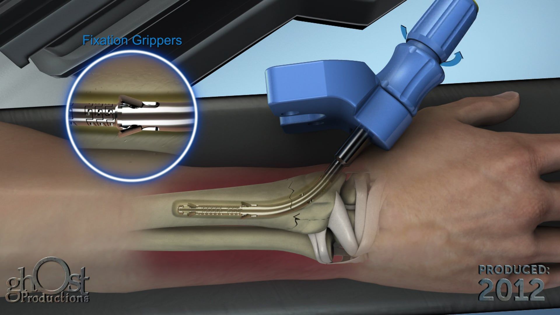 Sonoma Orthopedic Products, Ghost Productions, WRx intermedullary device, fractures, long bones, stable fixation, faster healing times, medical professionals, patients, orthopedic medicine.