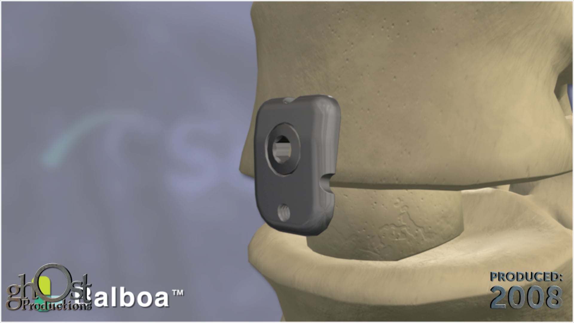SeaSpine, Ghost Productions, Balboa device, Anterior Buttress Plate, spacer migration, spinal surgery, cutting-edge technology, game-changer, surgeons, reliable, effective solution, spinal disorders, animation, key features, benefits, attention to detail, medical accuracy, healthcare professionals, patients.