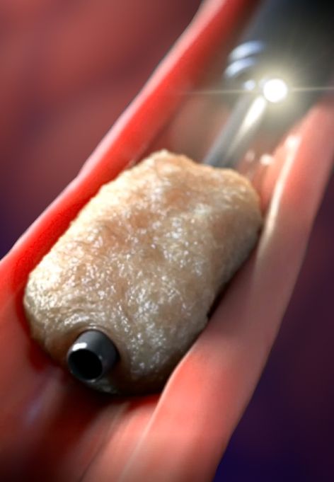 Animation showcasing the Piranha ER Sheath and Aspiration Catheter by Biomerics for treating esophageal food impaction. The Clinical Luminal Endoscopic Assessment of a Novel Suction (CLEANS) Technique is demonstrated, using the Piranha GI Aspiration Catheter to suction food away from the center of the impaction. This reduces the food bolus volume, allowing for spontaneous passage into the stomach. Revolutionary medical device.