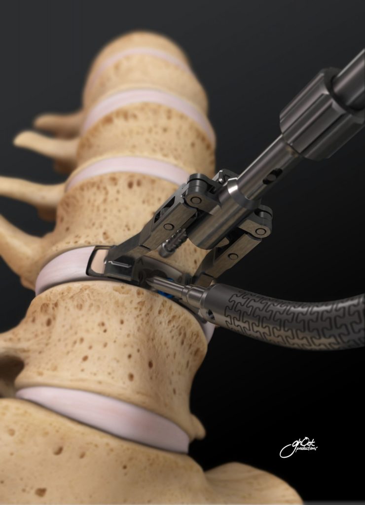 A medical animation by Ghost Productions demonstrates the implantation and benefits of the Aesculap Arcadius Stand-Alone Interbody Device for spinal surgery. The video showcases the device's features and advantages for patients. Expert narration and clear visuals make it a helpful resource for healthcare professionals and patients.