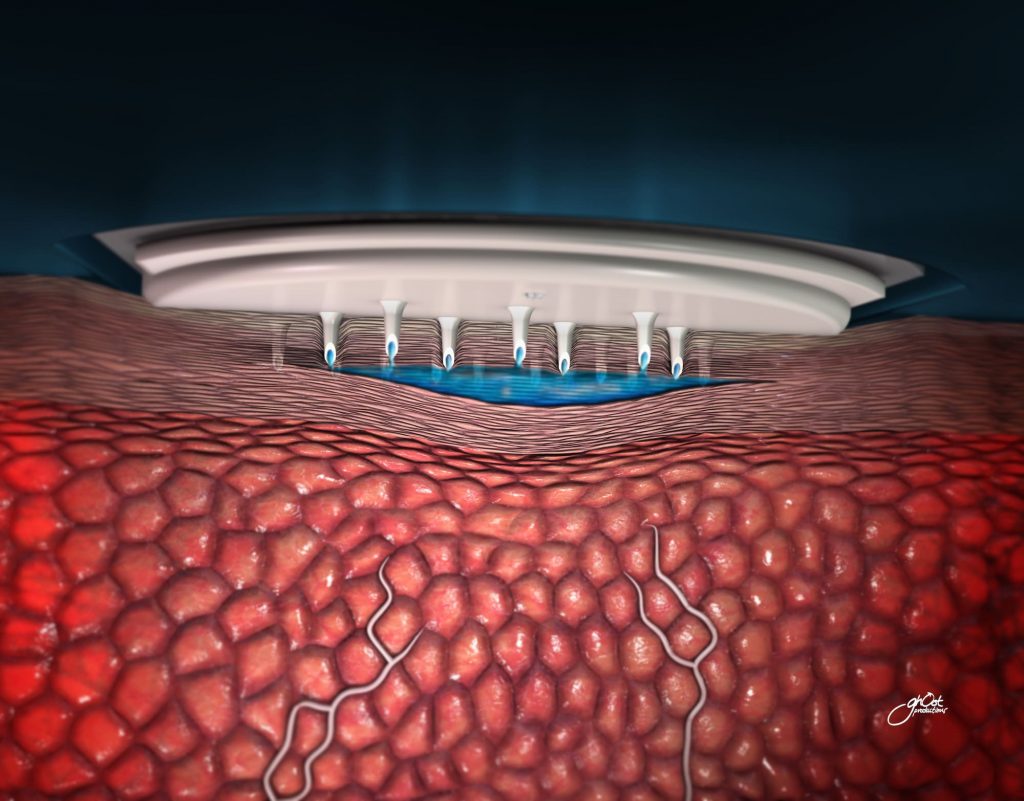 A range of 3M medical devices are displayed, including surgical tapes, dressings, wound care products, and skin protectants. These devices are made with advanced materials and technologies to provide superior performance and patient comfort. Trusted by healthcare professionals worldwide, they deliver optimal patient care outcomes.