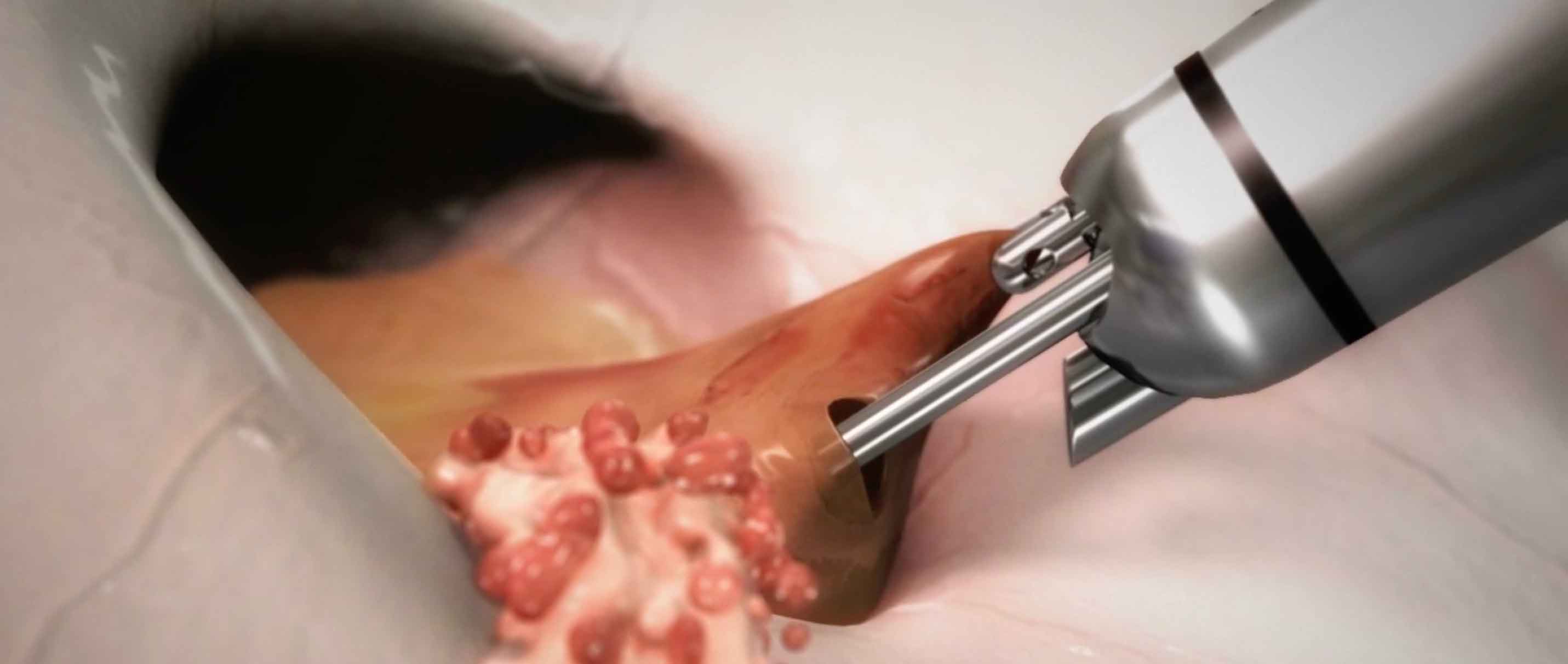 MINOP InVent, neuroendoscopic system, brain surgery, tumor resection, cyst resection, bi-manual technique, minimally invasive, neurosurgery, medical innovation, endoscopy, surgical instruments, medical illustration, intraventricular surgery, paraventricular surgery, optimized optics, surgical precision, angled instruments, advanced neurosurgery, brain health, surgical technology