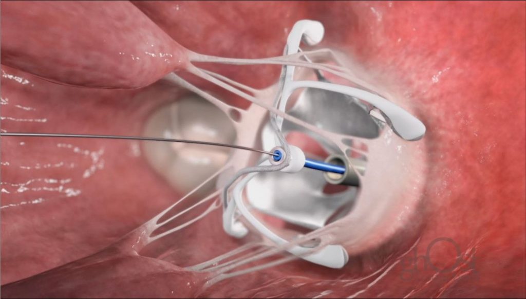 Transcatheter Mitral Valve Replacement Device, Caisson Interventional LLC, minimally invasive procedure, cutting-edge medical device, mitral valve replacement, cardiac surgery, open-heart surgery alternative, faster recovery times, reduced risk of complications, precision engineering, future of heart health, medical specialties: cardiology, interventional cardiology, cardiovascular surgery.