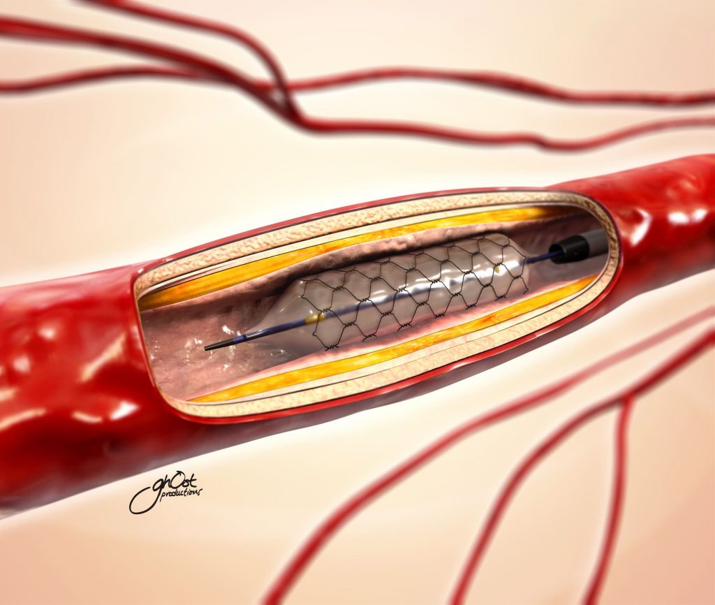 An animated commercial spot by Ghost Productions shows the expertise of the limb salvage team for peripheral vascular disease at the Cardiovascular Institute of the South. The commercial highlights cutting-edge treatments and personalized care provided by CIS to help patients overcome this condition and improve their quality of life. The commercial promotes CIS's services and educates the public about peripheral vascular disease.